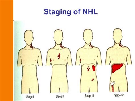 whats a burkin|burkins lymphoma.